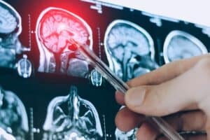 A Brain Aneurysm Isn’t Always an Emergency